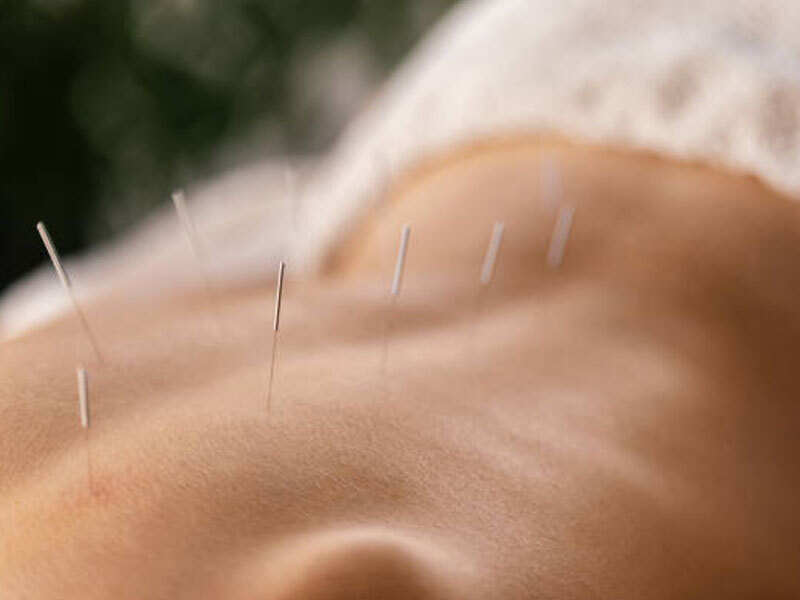 Benefits of Adelaide Dry Needling