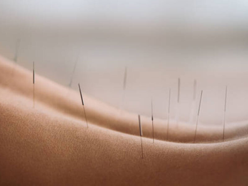 How does Dry Needling work